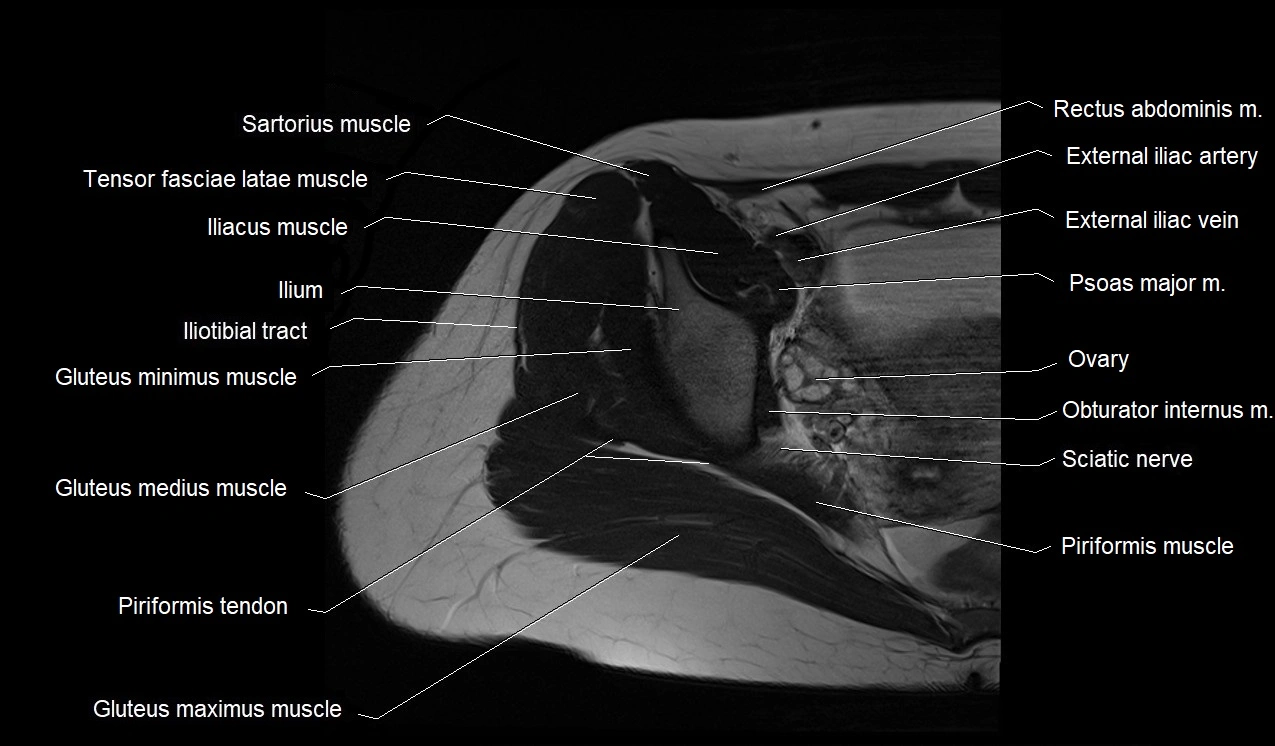 MRI thigh cross sectional anatomy image 3.webp